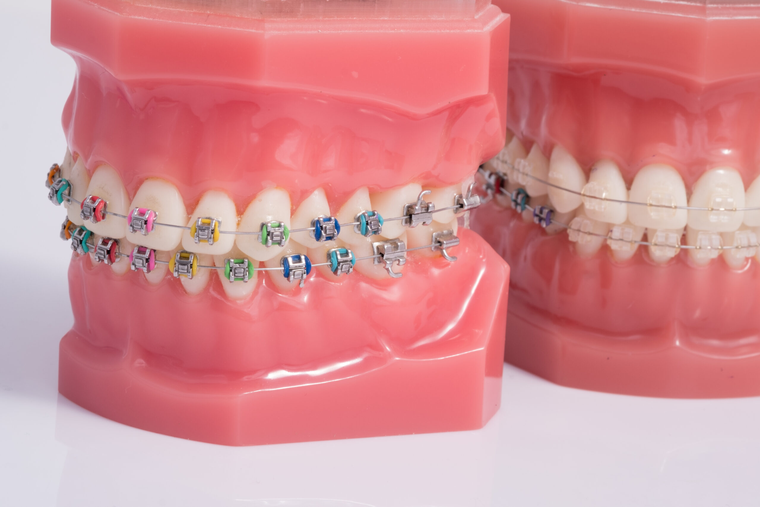 Dentist,Demonstration,Teeth,Model,Of,Orthodontic,Bracket,Or,Brace,With
